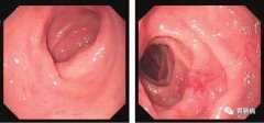 萎縮性胃炎不可怕，只要