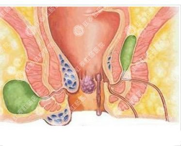 南寧哪個醫(yī)院可以做肛周膿腫？